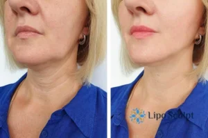 Double chin before and after Hi-Fu treatment 4 Book your double chin treatment Drayton today! We are here to help!