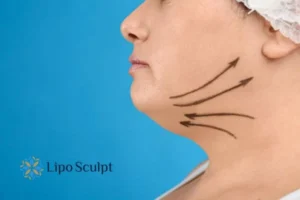 Double chin before and after Hi-Fu treatment 3 Boost your confidence with a Double chin treatment Drayton