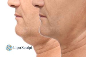 Double chin before and after Hi-Fu treatment 2 Double chin treatment Drayton from Lipo Sculpt - feel more confident today!