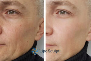 How to Fight Aging Symptoms 3 Fight Aging Symptoms Drayton With HIFU and Morpheus8 Today!