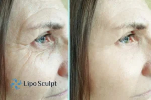 How to Fight Aging Symptoms 2 Do you want to Fight Aging Symptoms Drayton? Contact Lipo Sculpt today!