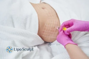 Are The Results From Aqualyx Permanent? 1 Do you want to know how long Aqualyx Drayton results last?