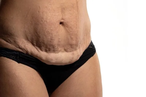 Lost the Weight but Not the Loose Skin? 1 image of womans stomach after weight loss showing loose skin Drayton